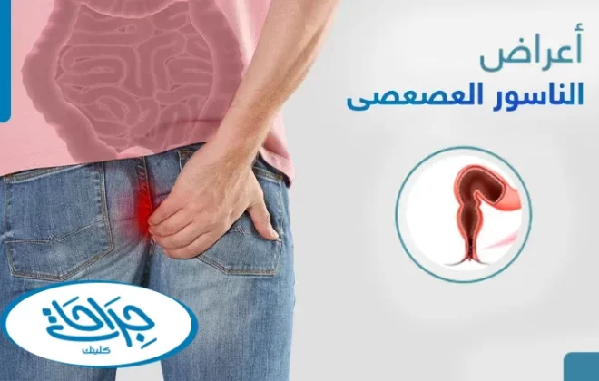 اعراض الناسور العصعصي