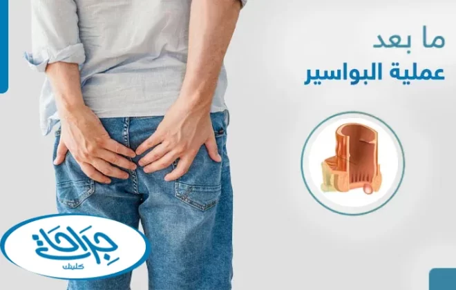ما بعد عملية البواسير