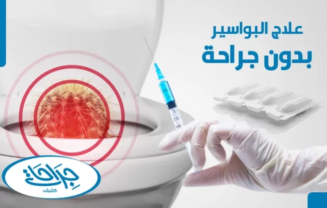 علاج البواسير بدون جراحة