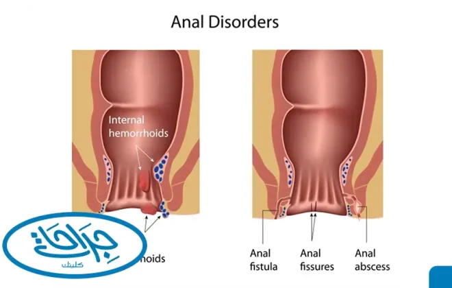 الفرق بين الناسور والبواسير