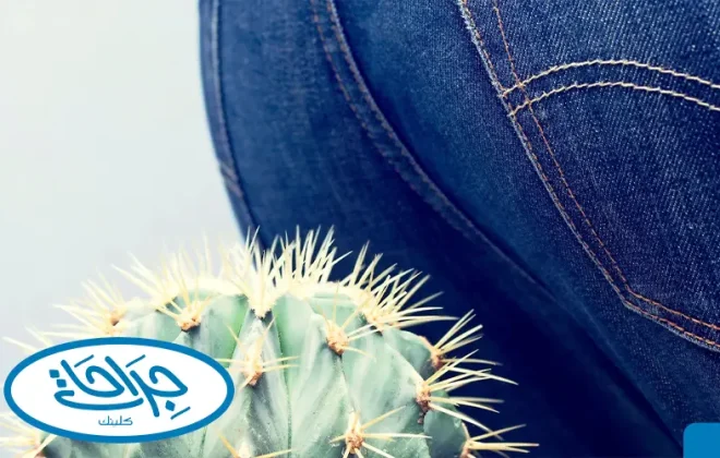 علاج البواسير عند النساء