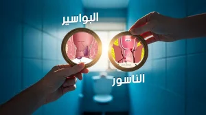 الفرق بين الناسور والبواسير بالصور