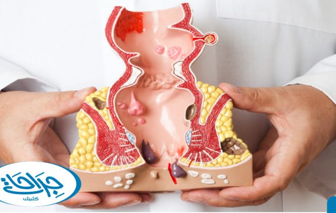 الفرق بين البواسير والسرطان