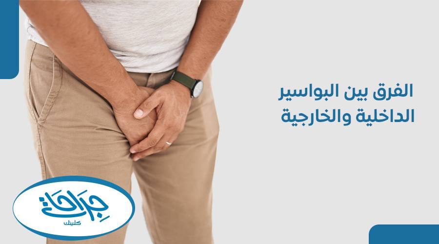 الفرق بين البواسير الداخلية والخارجية