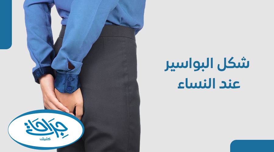 شكل البواسير عند النساء