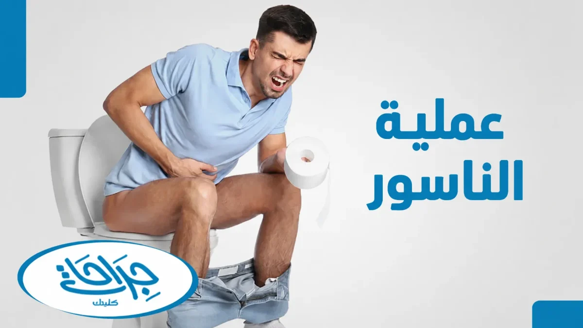 عملية الناسور
