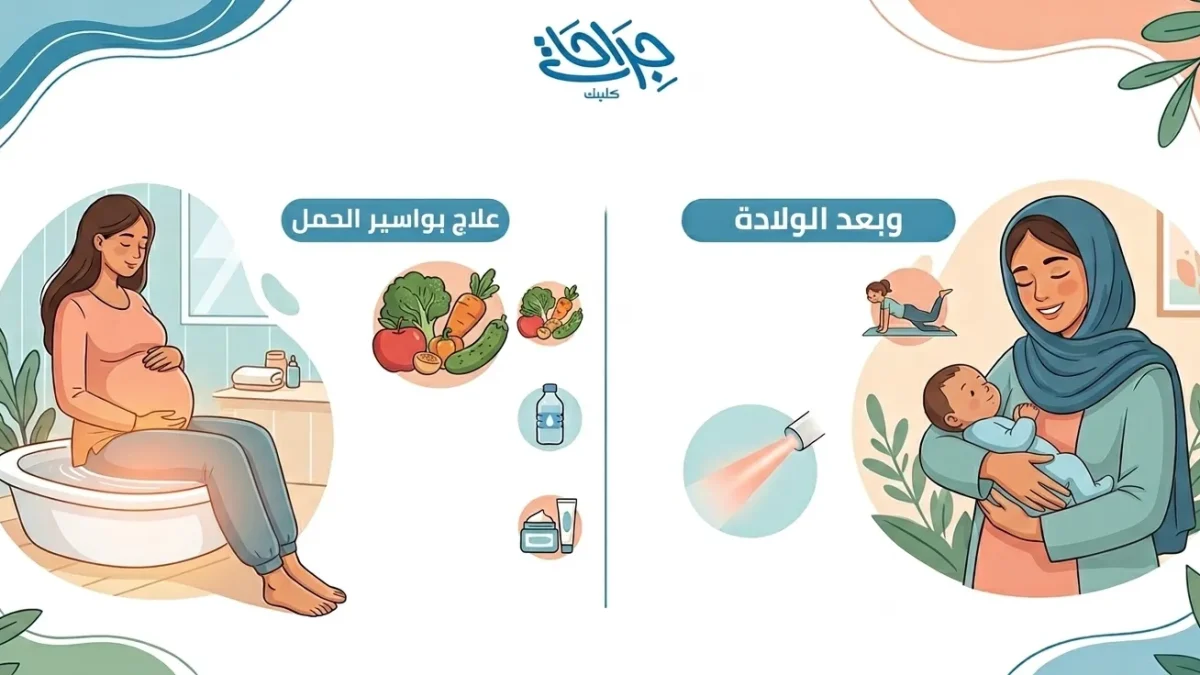 علاج بواسير الحمل وبعد الولادة