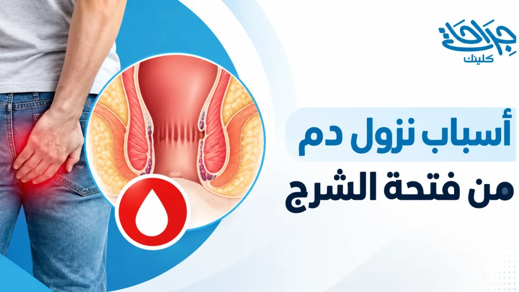 اسباب نزول دم من فتحة الشرج